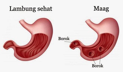 Apa Bedanya Maag dan GERD? Penjelasan Lengkap dari Dokter Spesialis